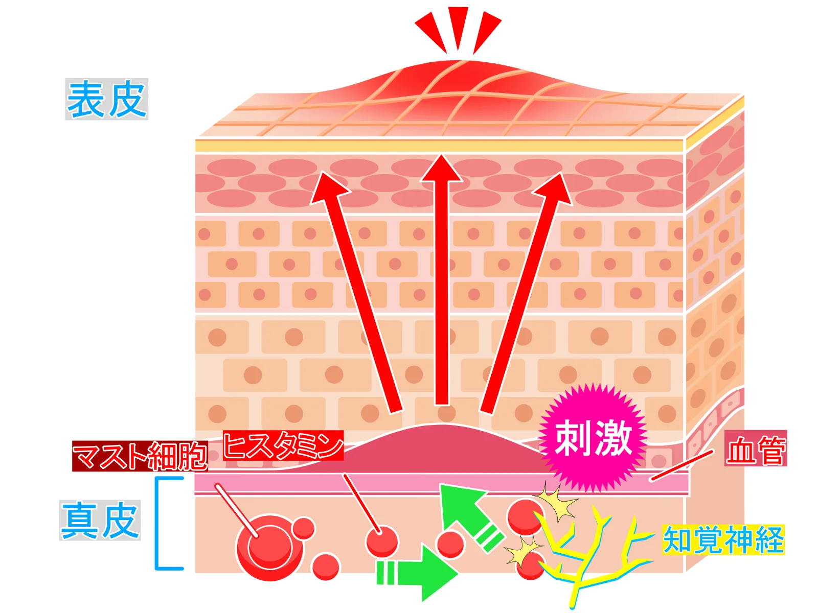 じんましん | 府中市の形成外科 皮膚科 美容医療なら府中ことぶき町